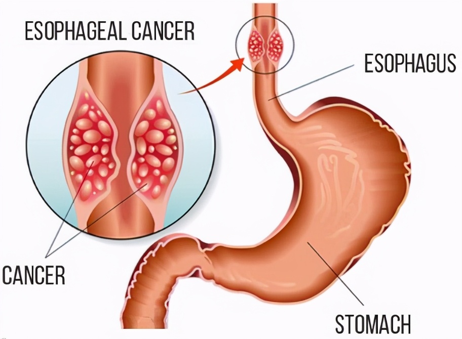 食管癌特效疗法欧狄沃获欧盟推荐批准，二线治疗显著延长生存期