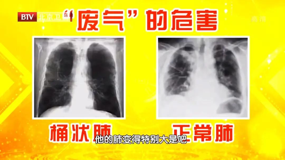 老慢支老不好，总是憋闷咳？这样吃和做，让呼吸更省力