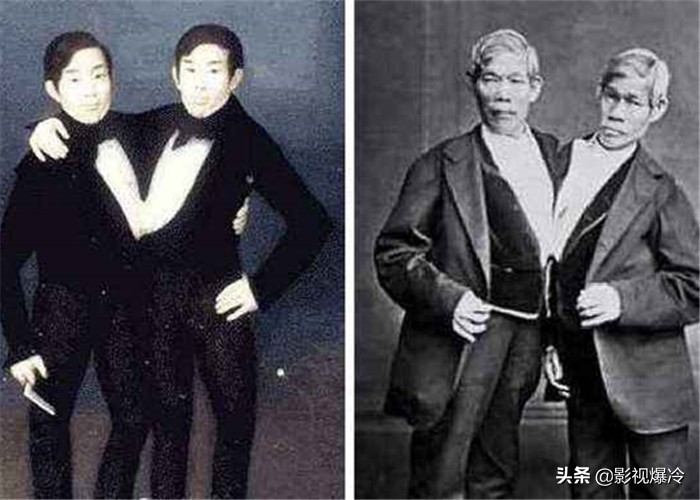 “最奇特的双胞胎”，一个死了另一个会怎样？