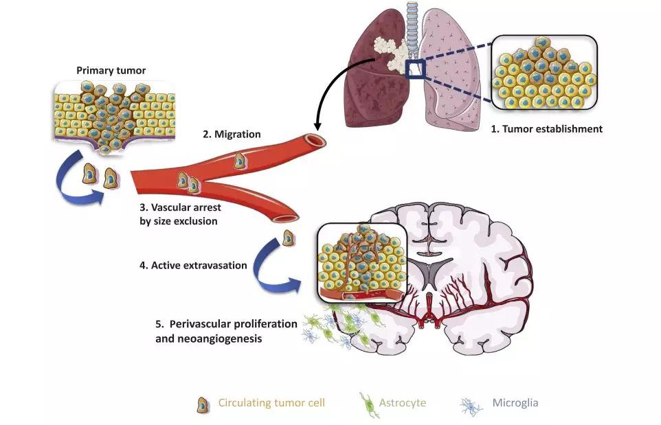 Is immunotherapy effective for brain metastases from lung cancer? - iNEWS