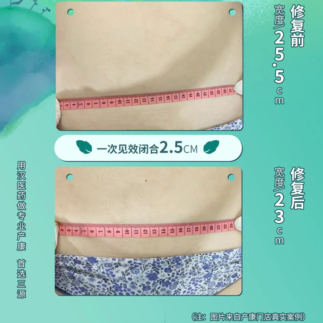 骨盆修復(fù) | 打響骨盆保衛(wèi)戰(zhàn)！重塑女人青春源