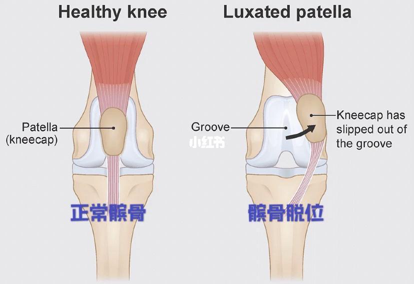 走路膝關節總髮軟當心髕骨脫位 人民健康百科 Mdeditor