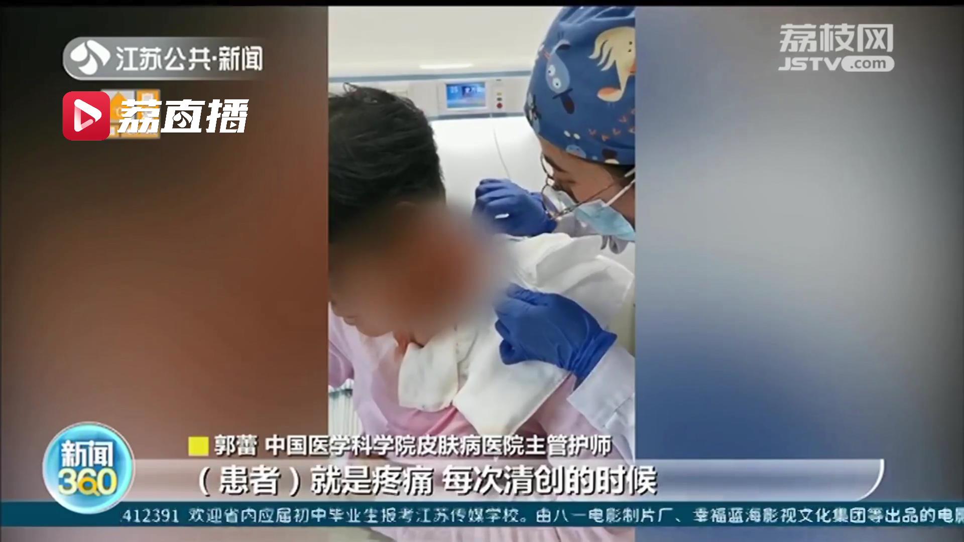 染发有风险！女子染发致头颈部大面积感染 医生建议使用产品前应局部试验