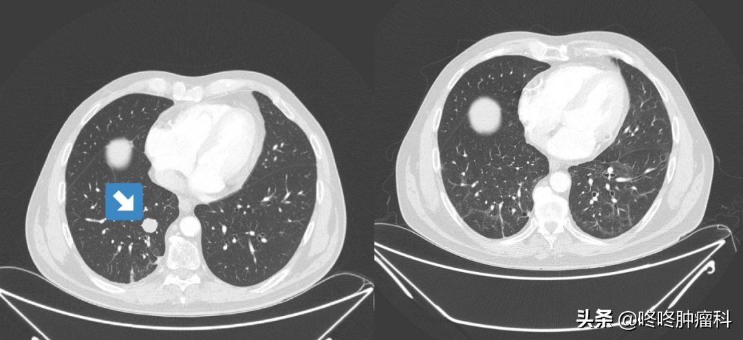 新冠肺炎真能“治愈”癌癥？這樣的案例再次發(fā)生了