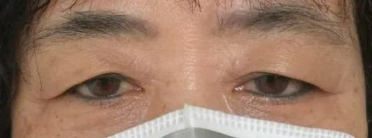 科普——眼整形手术是个什么手术?(多图)
