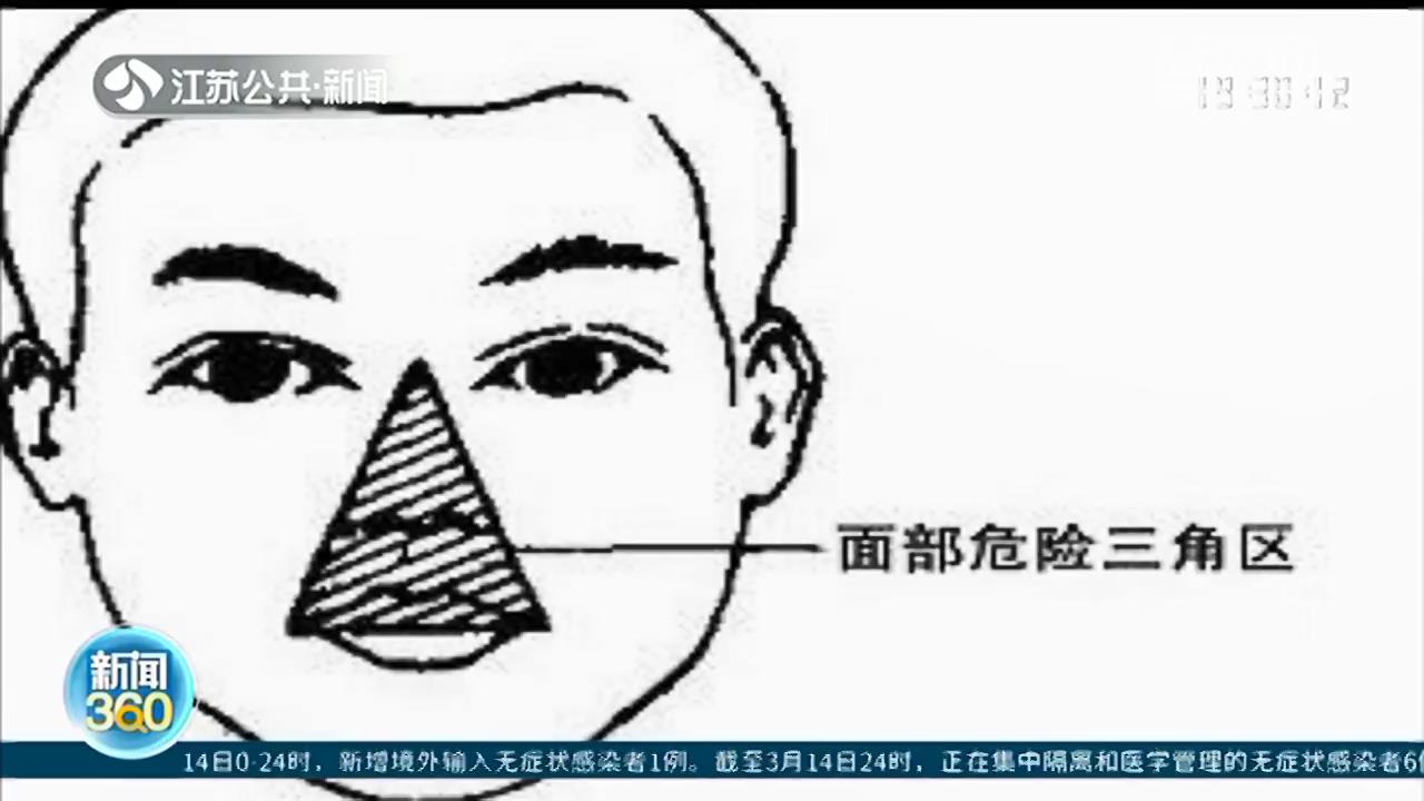 男子挤痘痘，引发颅内脓肿导致瘫痪，&ldquo;危险三角区&rdquo;别乱碰