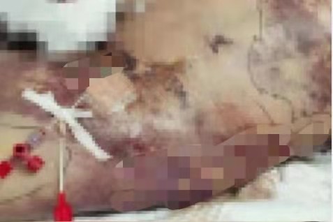 抽脂手术失败后，患者的身体会发生什么变化？抽脂手术有多可怕？