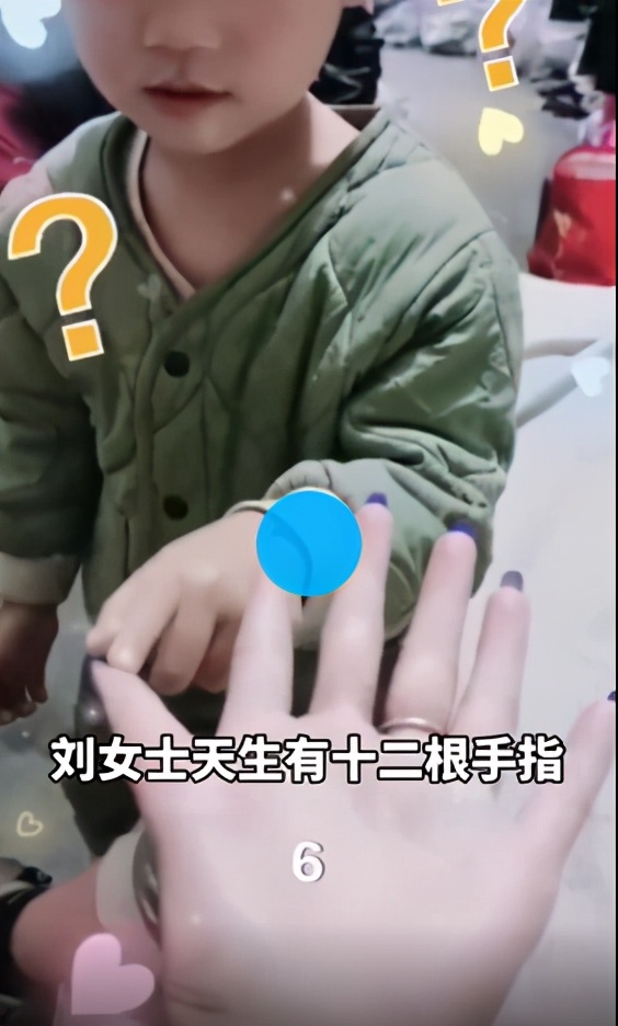 「12根」女子天生12根手指自嘲六指琴魔 心态乐观自侃做美甲费钱