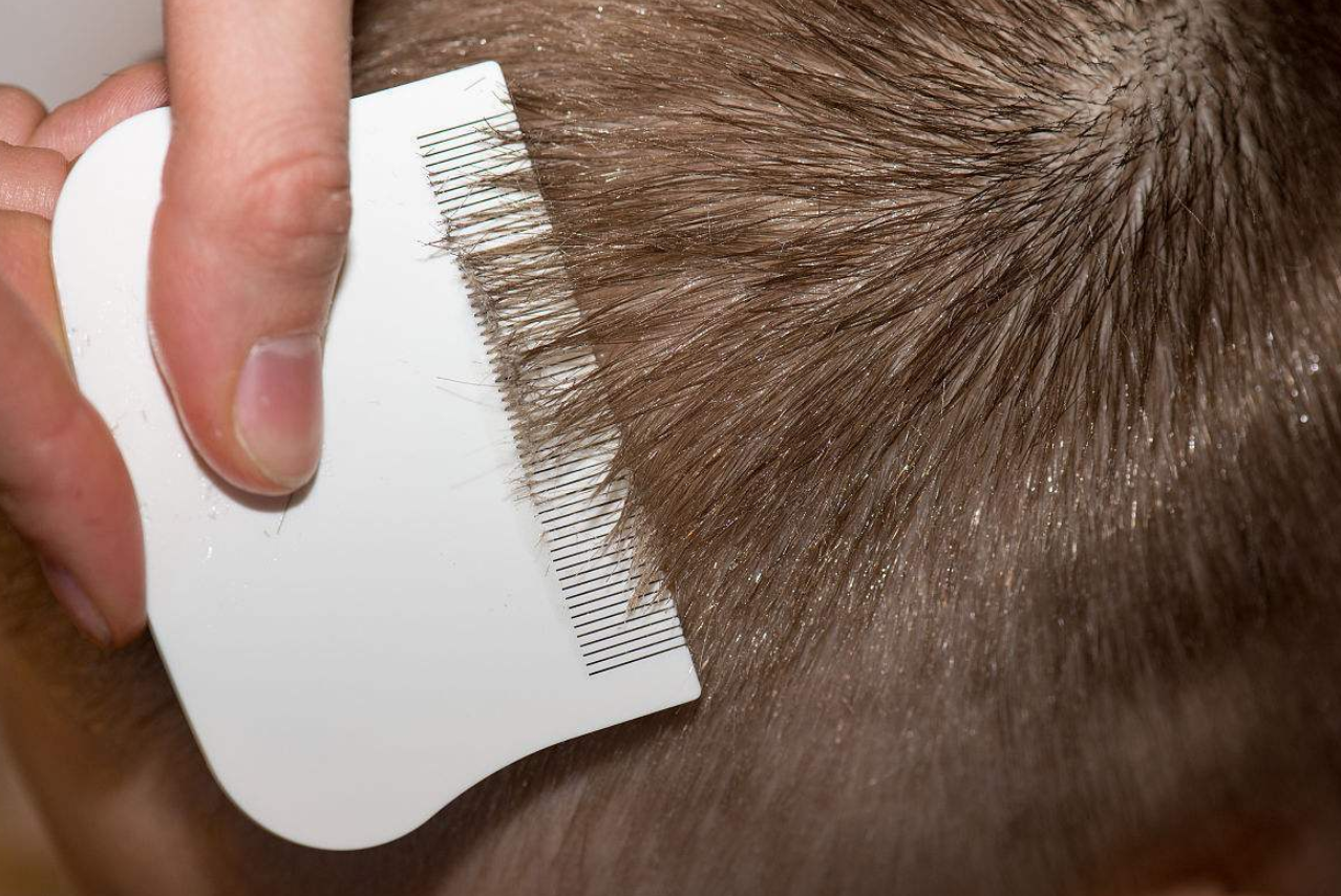 幾十年前農村很多人頭上都有蝨子 為何如今突然沒了 環球科學貓 Mdeditor