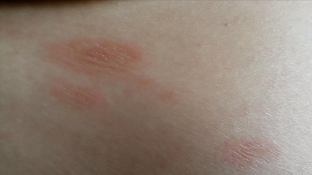 Is pityriasis rosea contagious? - iMedia