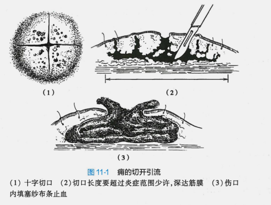 古代时很多人因为背部长疮而死，医生：这种疮现多见于糖尿病患者