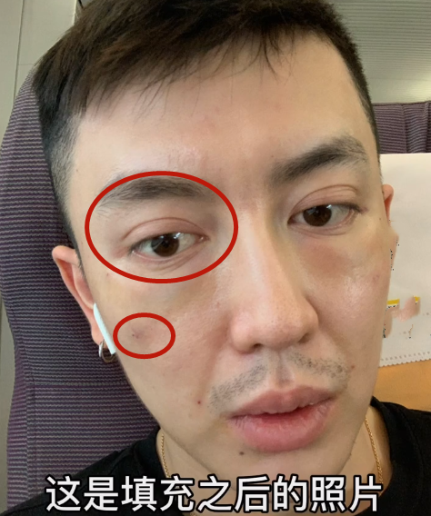 男网红整容失败 直播痛哭脂肪填充之后老了岁 前后对比没法看 柠檬味的娱乐圈 Mdeditor