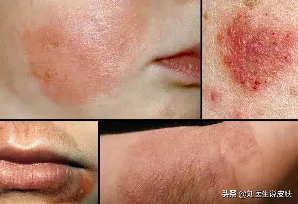 Eczema keeps coming back and forth, is it because the skin is too "wet