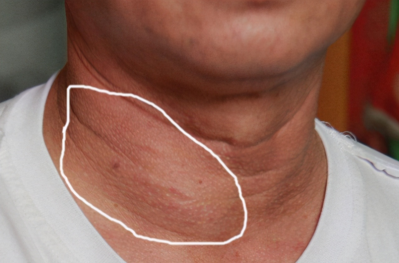 People with thyroid nodules can't eat seafood?The doctor reminded