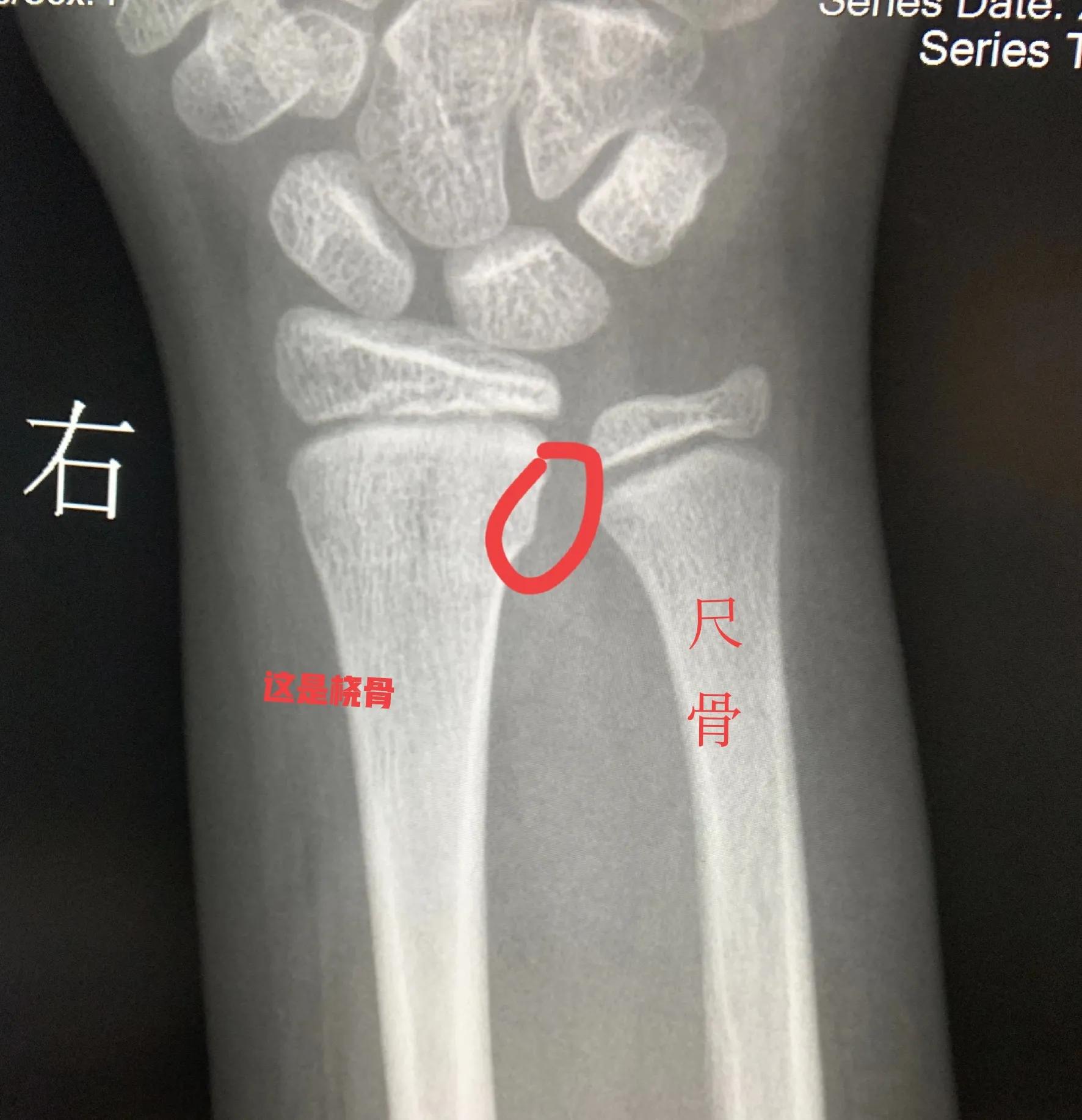 為什么小孩比較容易出現的青枝骨折,x光又該怎麼看怎麼診斷呢? - 資訊咖