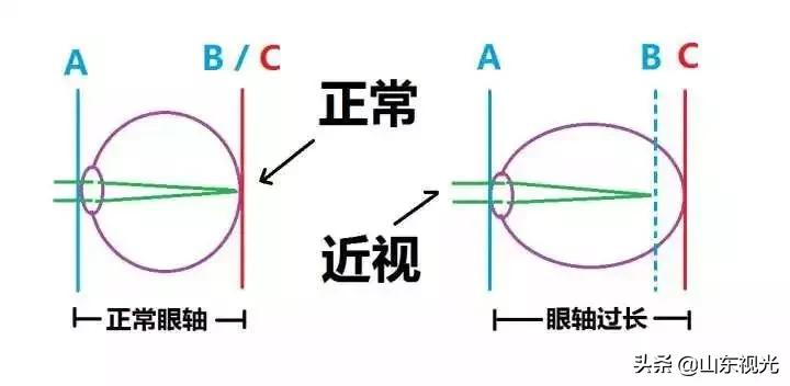 「科普」眼軸每增加1mm,近視就增加300度? - 資訊咖