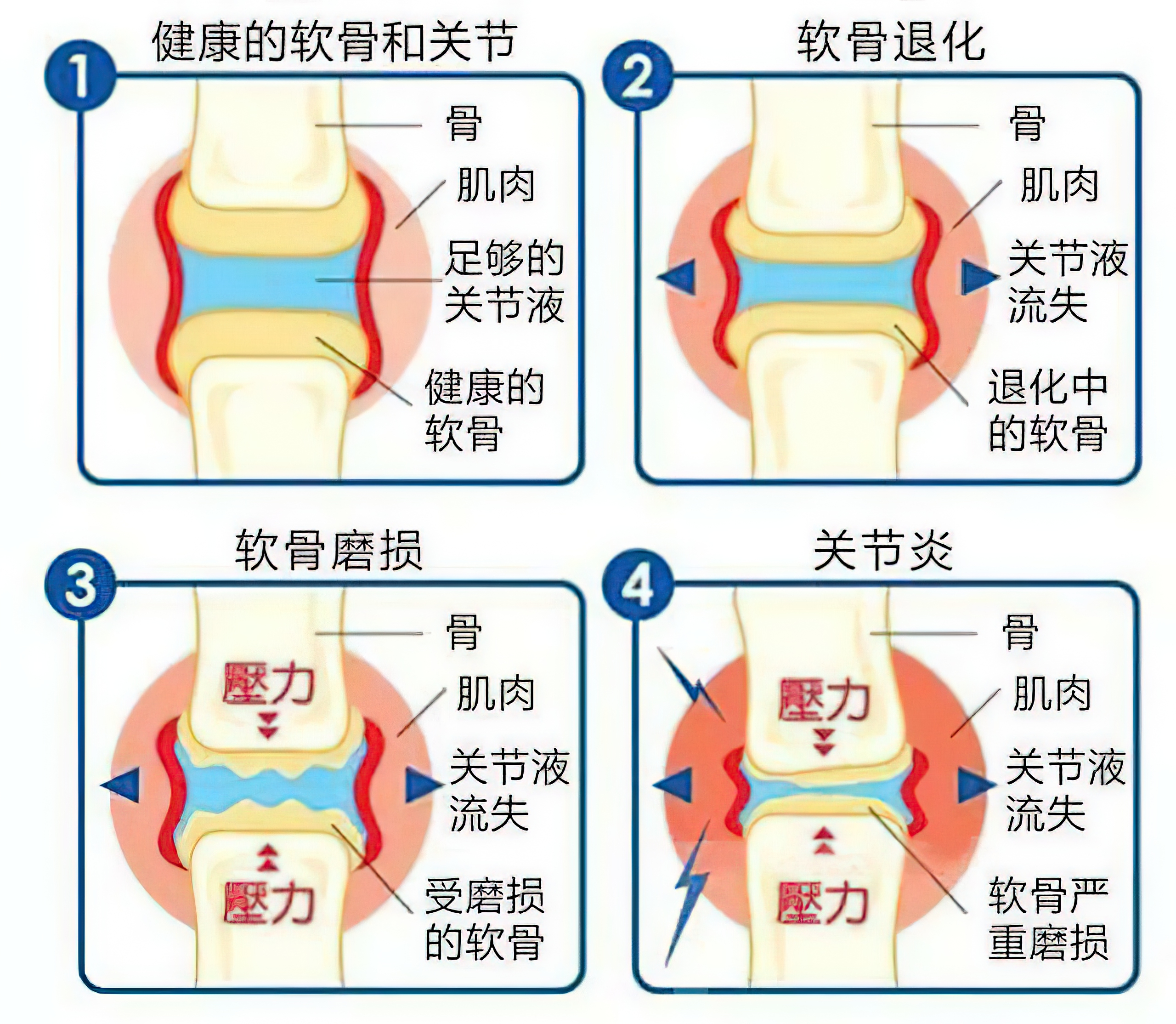 骨关节炎患者疼痛发作，只贴膏药管不管用？