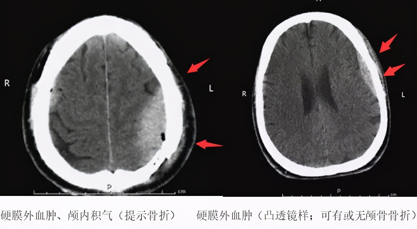 认识这几种头颅 CT，值夜班稳了