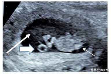 怀孕后早孕期B超图怎么看？医生详解，图文并茂