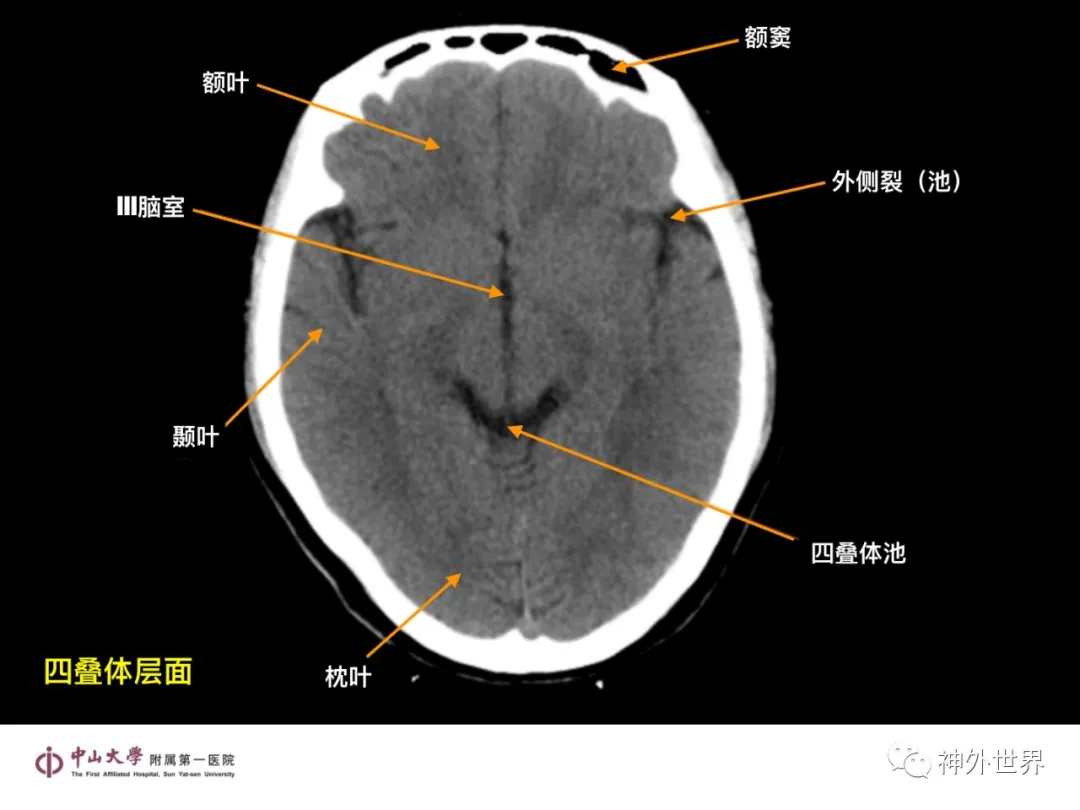 最全影像总结 | 颅内病变 MR、CT 的阅片技巧，太赞了