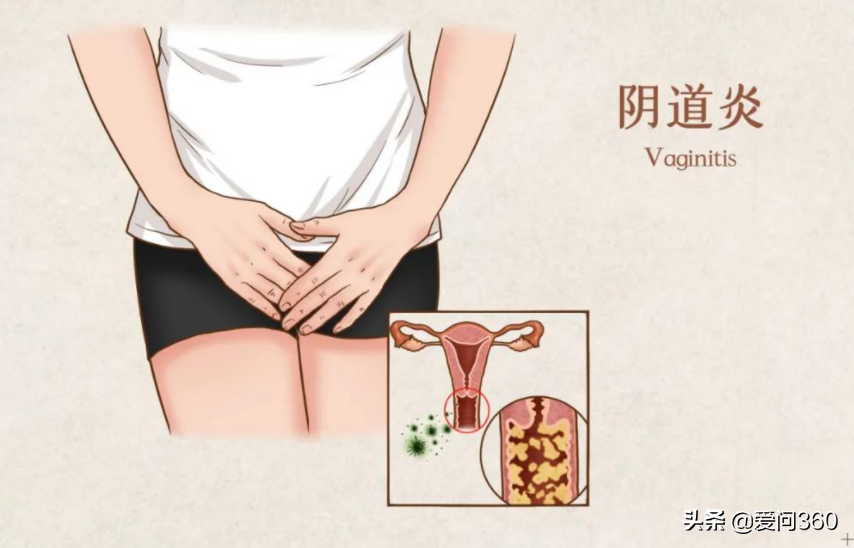 陰道炎容易反復發作，用這6個方法提前預防陰道炎的發生