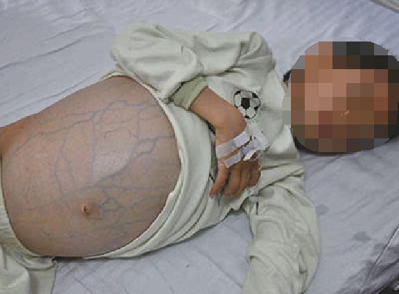 什么是腹腔积水？腹腔里为什么会有水？
