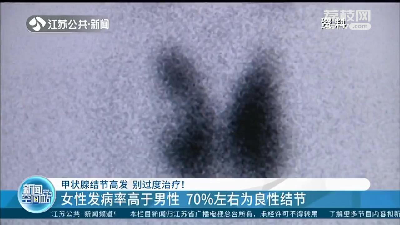 女性发病率高于男性、70%左右为良性结节 甲状腺结节别过度治疗