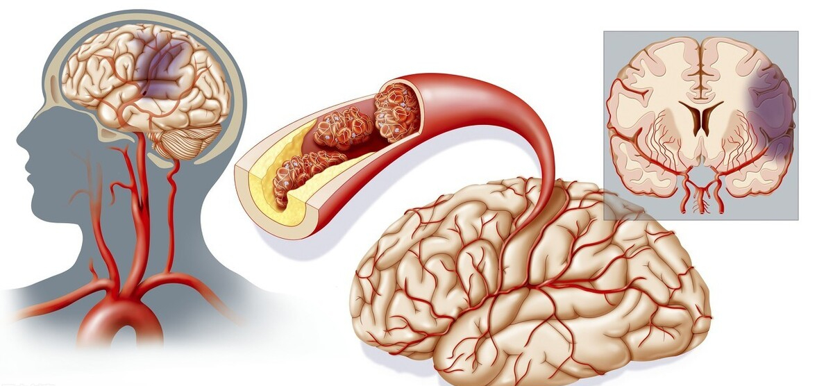 脑中风的原因不都在脑，有一种脑中风来源于心脏