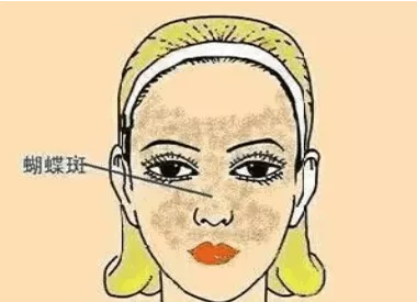 爱美女士看过来!注意这7点,轻松赶走蝴蝶斑