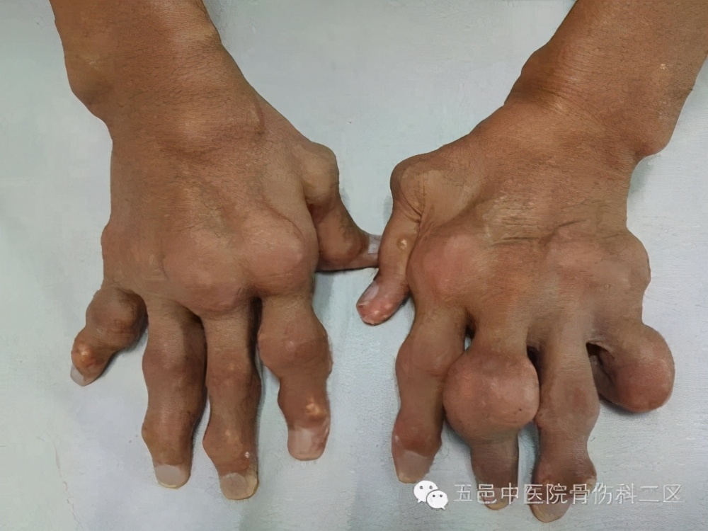 得了痛風，疼的不能走路，到底該如何治療痛風？ 醫生教你遠離痛風