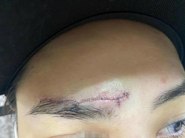 阿娇晒出多张伤口照片让人心疼右眉布满针脚恐将留疤