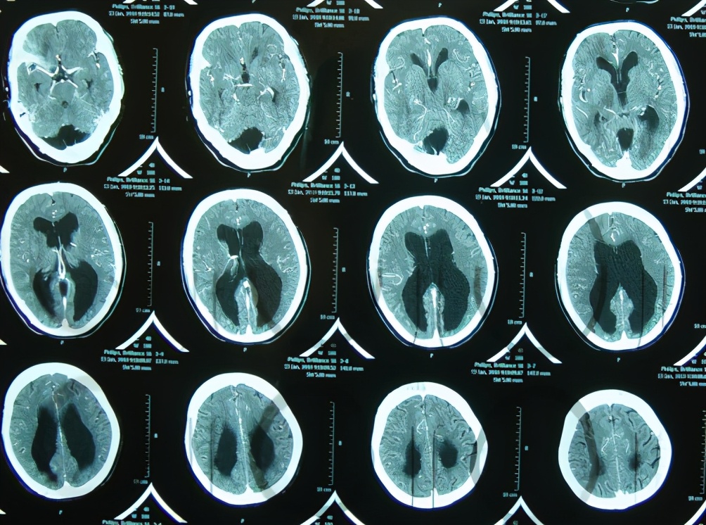 入院次日查头部ct增强和核磁发现后颅窝枕大池蛛网膜囊肿(图-2,图-3)