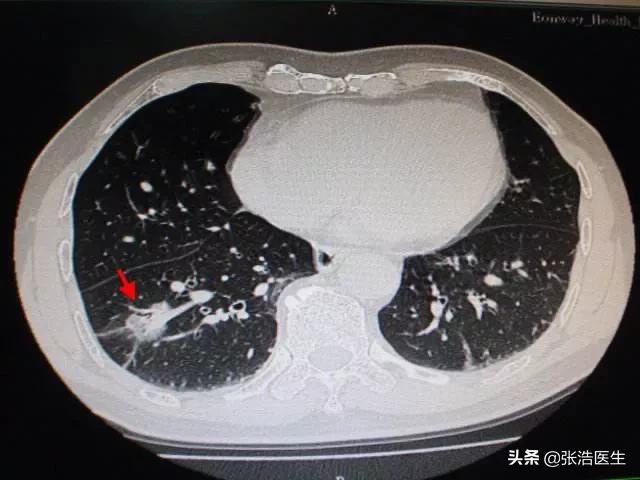 三个月前体检报告正常，为什么现在检查直接是肺癌晚期？