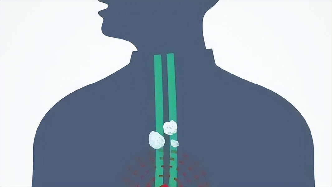 Coughing up these 4 colors of phlegm indicates that the spleen and