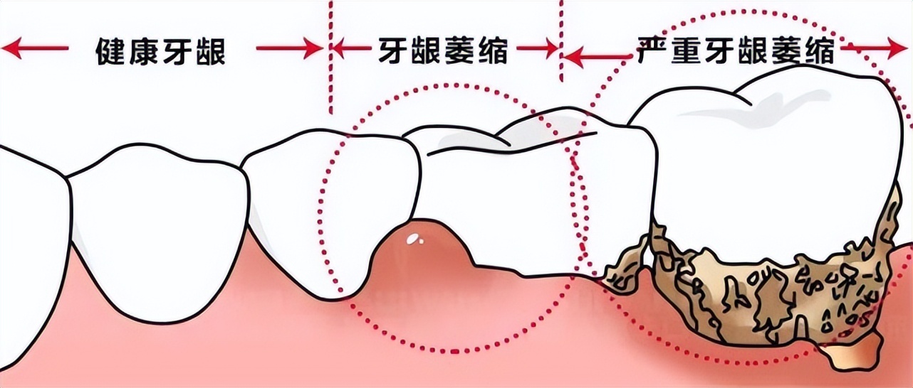 What's the matter with the teeth getting longer and longer? - iNEWS