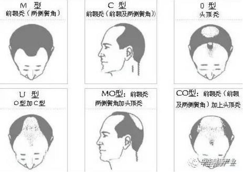 Hair loss science 5 common types of hair loss and the difference