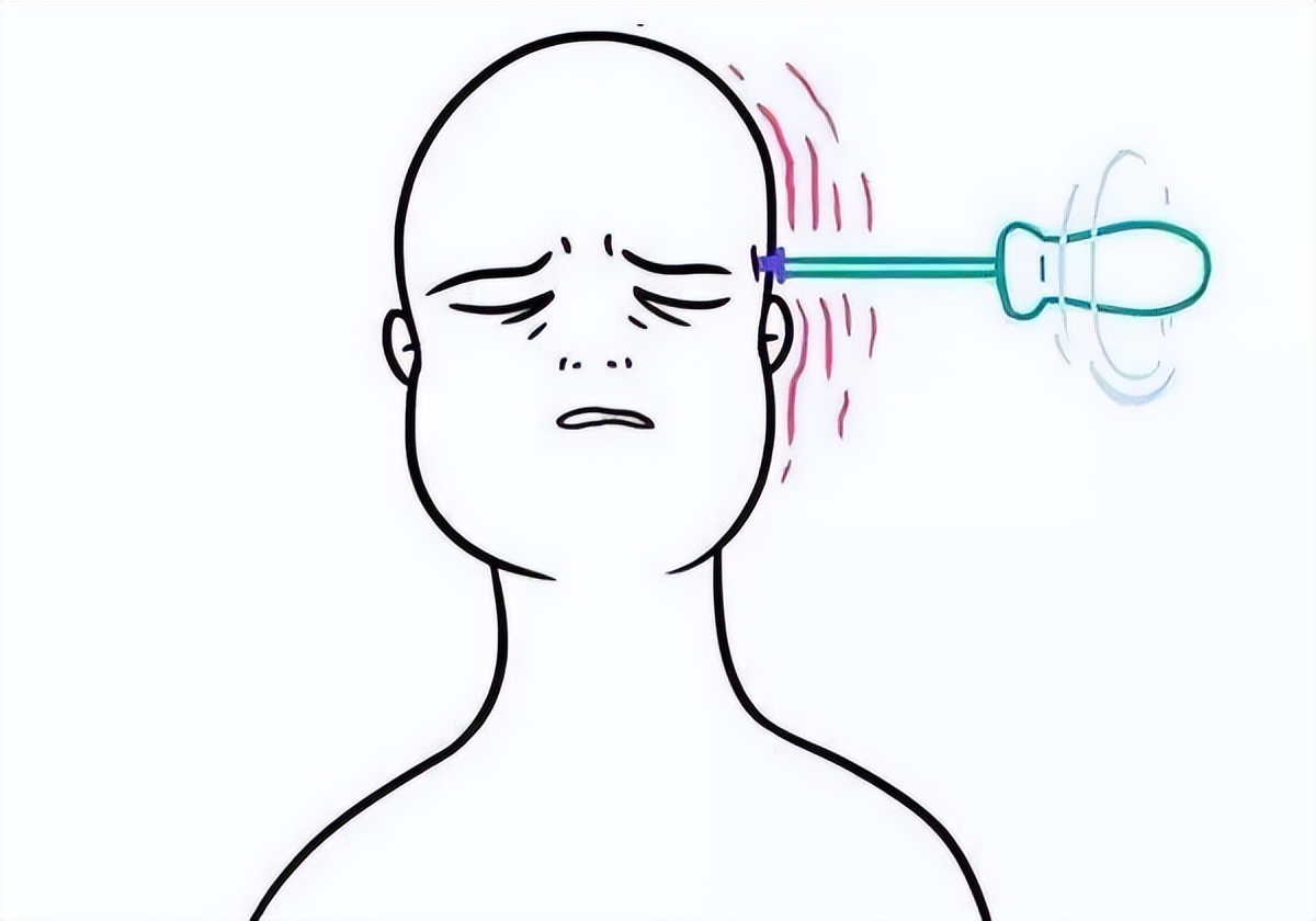 Xiehe Science Migraine is only one side of the skull hurts?All about