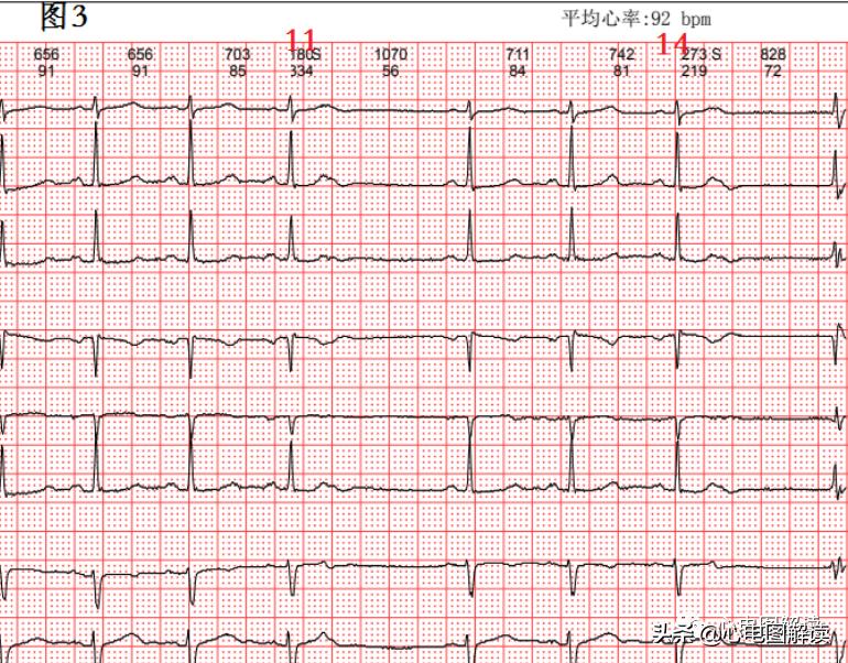 Atrial premature beat, atrial premature beat, scatter plot iNEWS