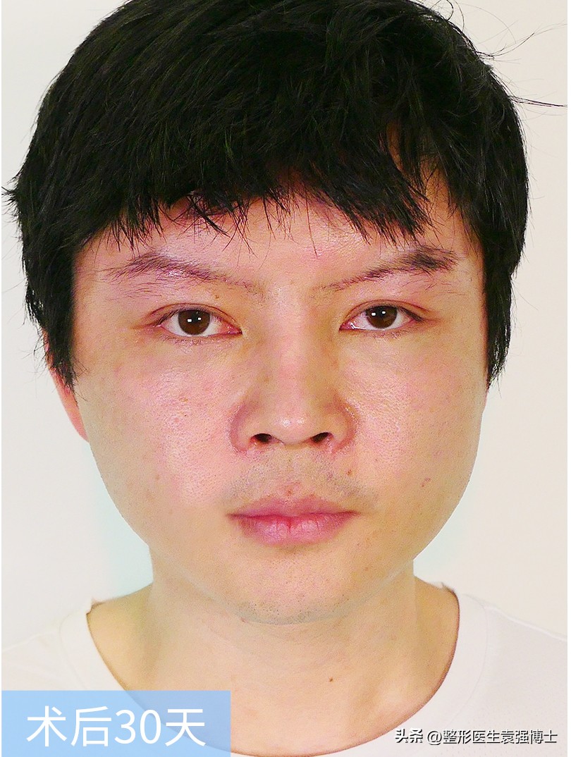 Is There An Age Limit For Facelift Surgery Can t Exceed 3 Times In A Lifetime Hear The Doctor 