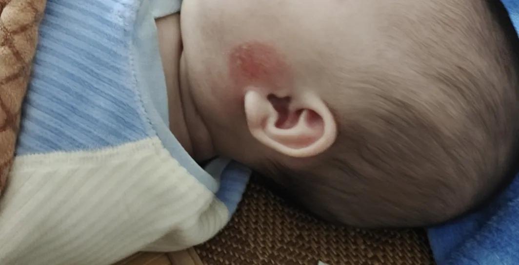 What is the best way to get rid of baby eczema? iNEWS