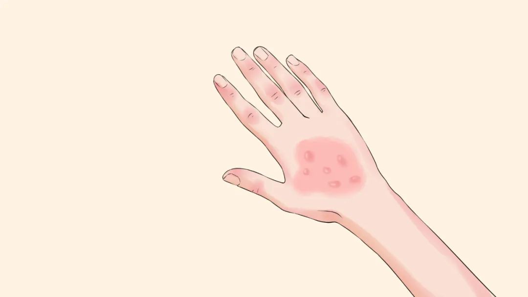It is contagious when you touch it. These 3 types of ringworm are very