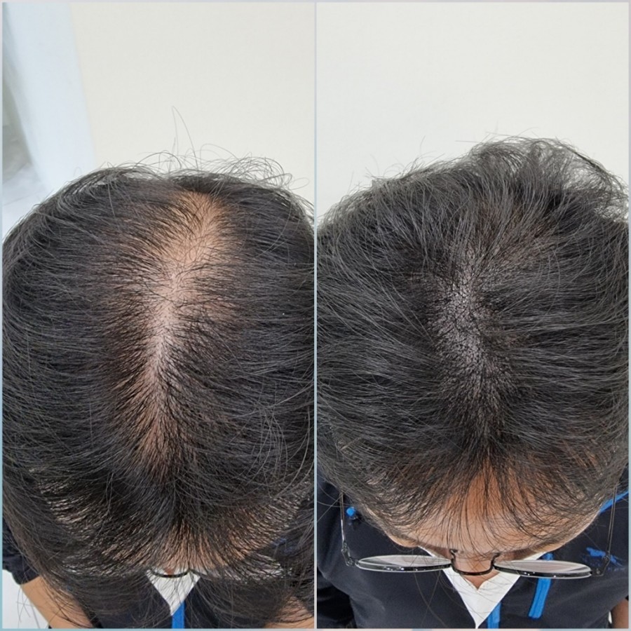 A New Breakthrough In Hair Loss Treatment: The Regeneration Rate Is As ...