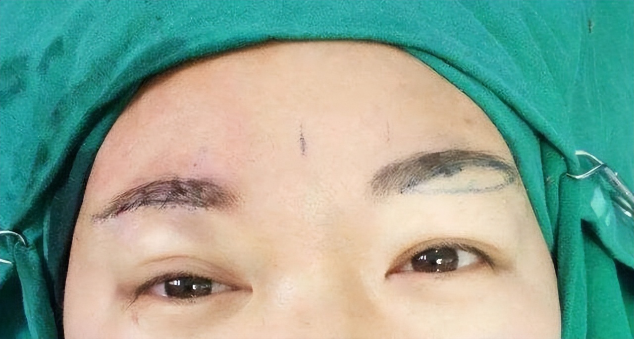 a-person-who-has-done-brow-lift-surgery-reminds-me-these-6-truths