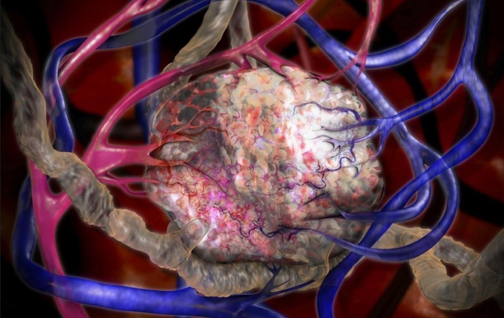 Can't kill cancer cells? How about trying to put the tumor into