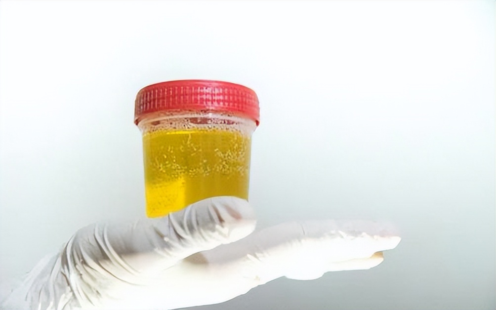 Unusually yellow urine after waking up in the morning?Doctor Or this