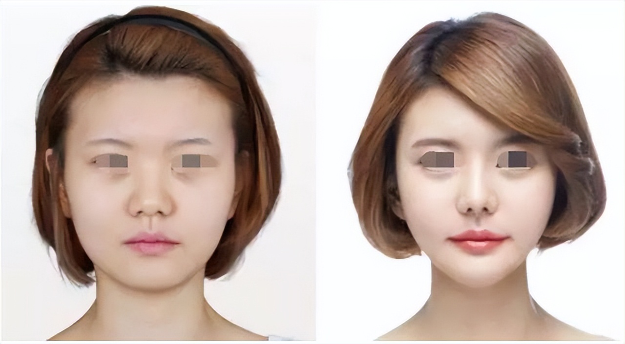 45yearold full face plastic surgery 90 days "cooked woman's face" to