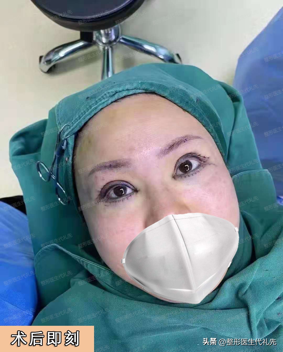 A 45yearold came to Beijing with a hot head to do double eyelid