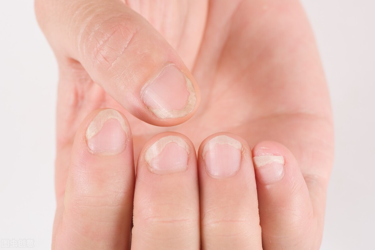 Malnourished?Signs of disease?Are vertical lines on your nails related