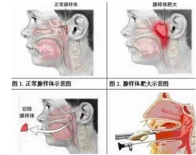 今天來解答好多家長的疑惑,孩子腺樣體肥大到底是怎麼形成的? - 資訊咖