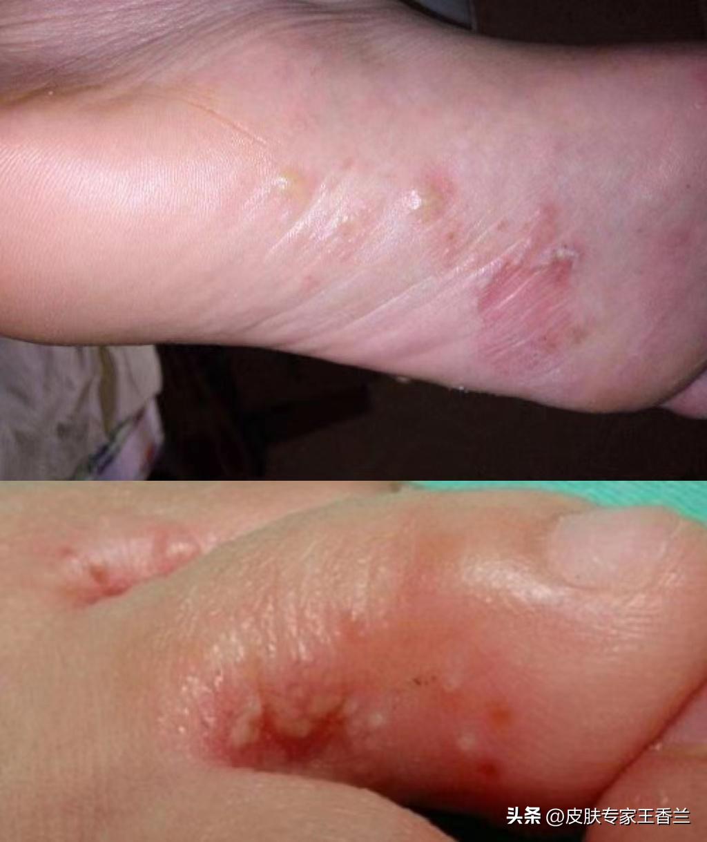 Are your athlete's feet always coming and going?Dermatologist probably